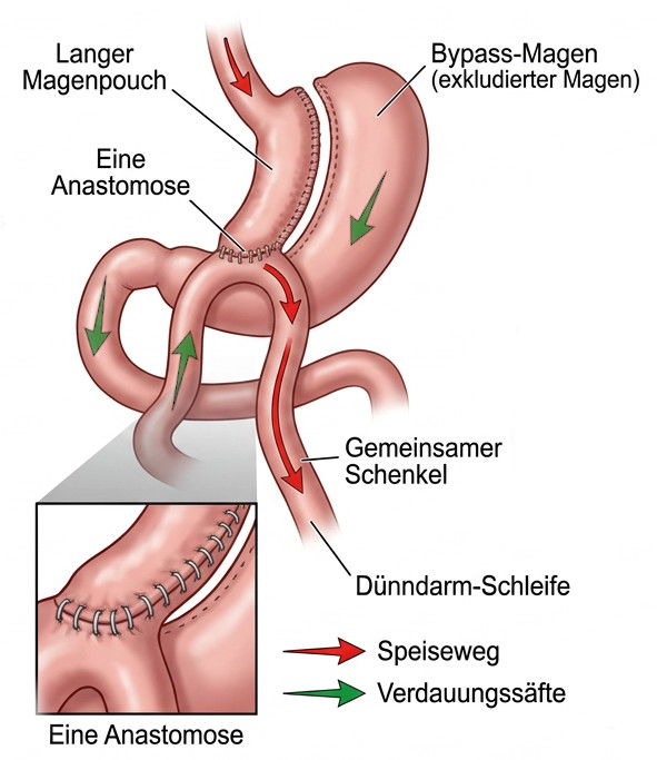 Die Grafik zeigt einen Magenbypass mit langem Magenpouch, ausgeschaltetem Magen und einer Anastomose; Pfeile markieren Speiseweg und Verdauungssäfte.