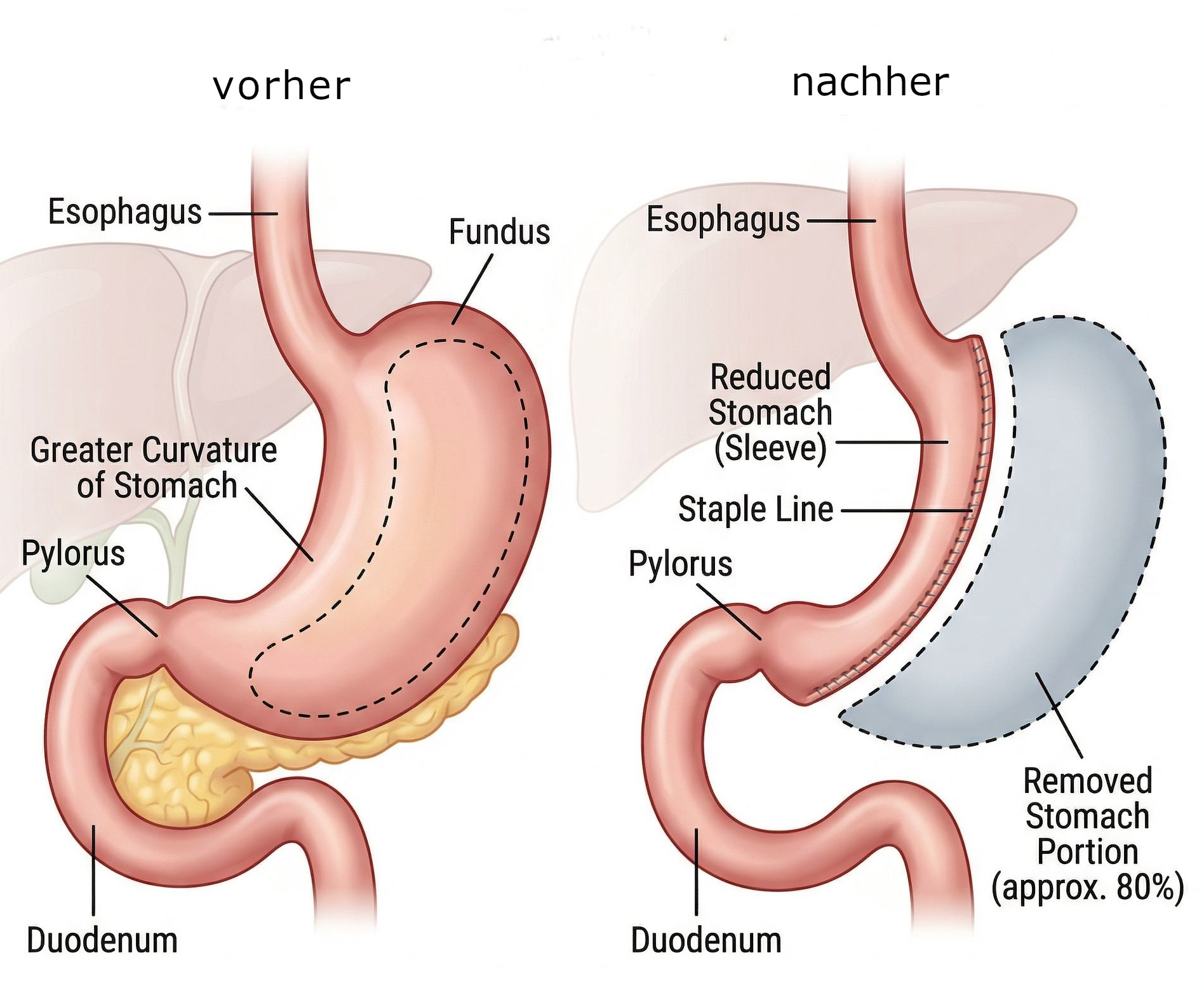 Diagramm der Sleeve-Gastrektomie mit Vorher-Nachher-Darstellung, zeigt Esophagus, verkleinerter Magen (Schlauch), Pylorus und entfernte Magenportion.