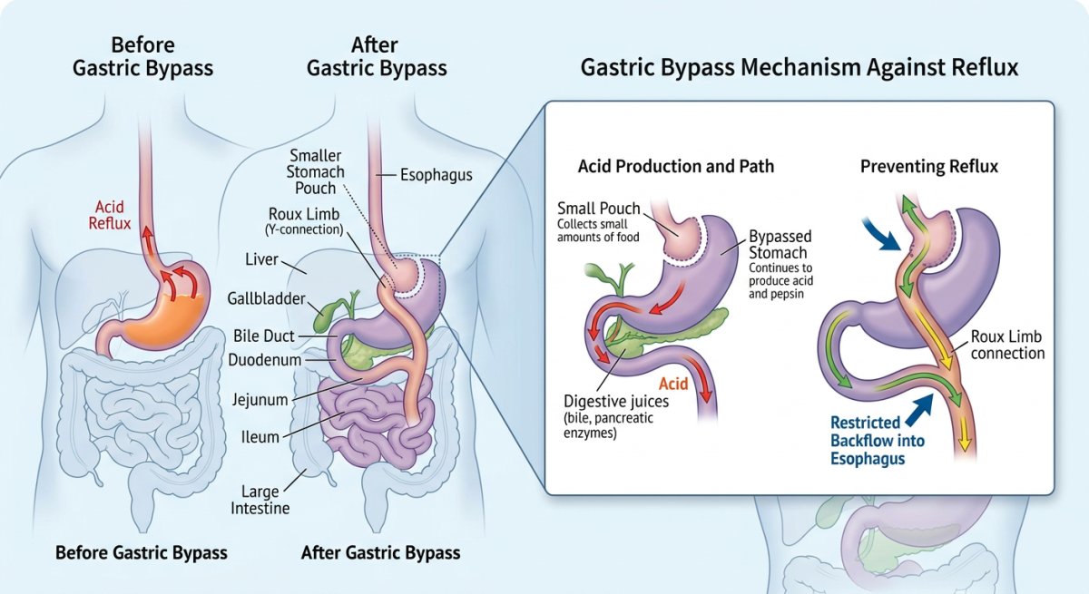 Magenbypass bei Reflux: Warum er der Goldstandard gegen Sodbrennen ist