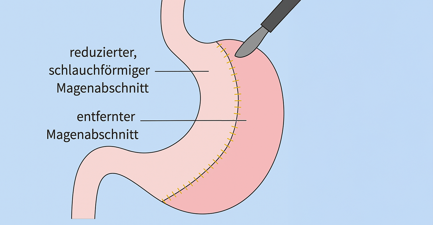 Diagramm, das den reduzierten und entfernten Magenabschnitt bei einer Magenverkleinerung zeigt.